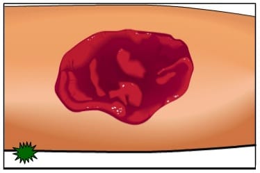 Module 4 : Wound Assessment Module 4 : Wound Assessment