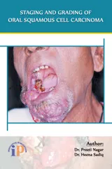 Staging and Grading of Oral Squamous Cell Carcinoma, First Edition, 2017, By Dr. Preeti Nagar, Dr. Heena Sadiq
